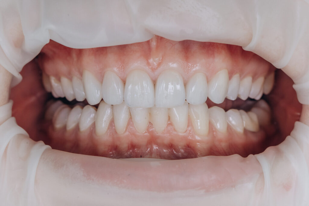 Dentamaris Dental Clinic Zirconium